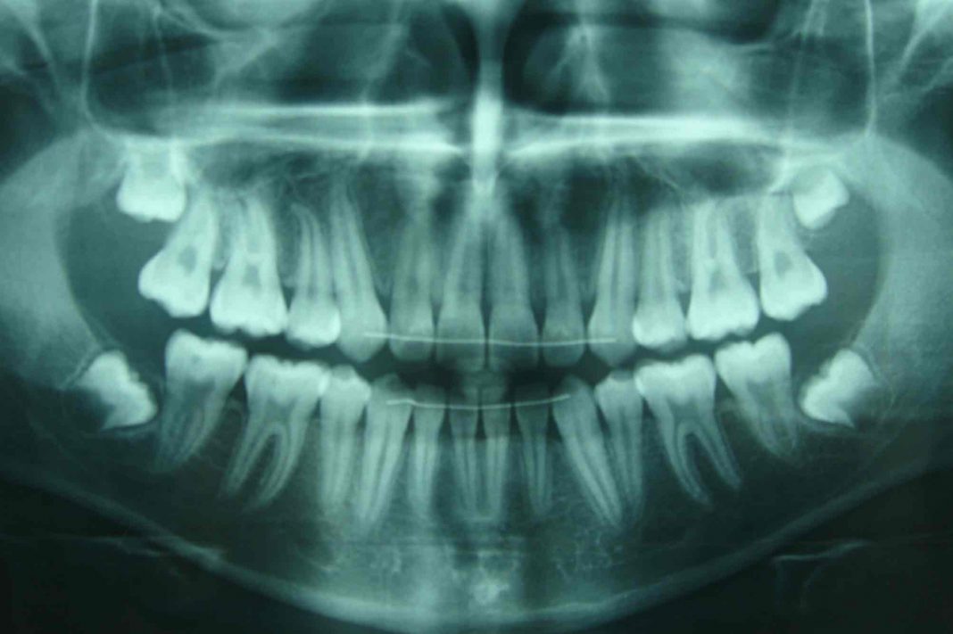 Il meurt 15 jours après son opération des dents de sagesse (détail